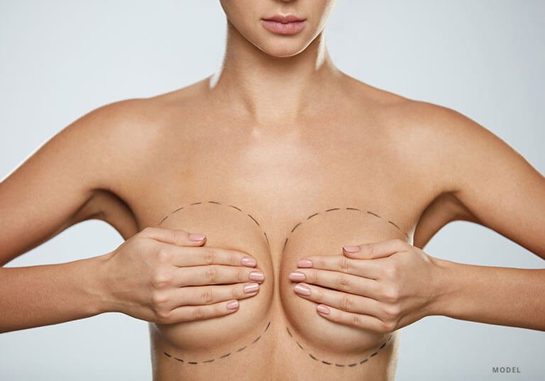 Breast Implant Revision Model
